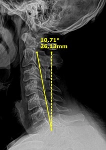 XRay Showing Neck Angle Before Chiropractic Care