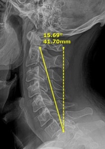 Chiropractic Dalton GA XRay After